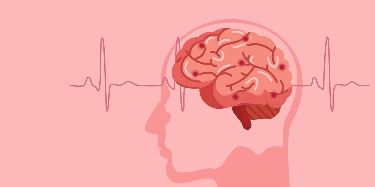 Инсульты можно предотвратить