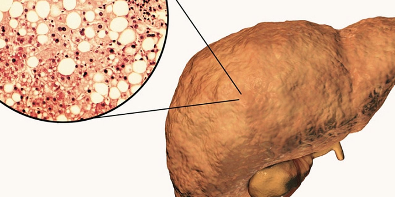 Вклад НАЖБП в сердечно-сосудистую заболеваемость при сахарном диабете 2 типа